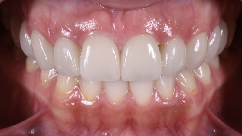Facettes céramiques, couronnes céramiques et implants dentaires