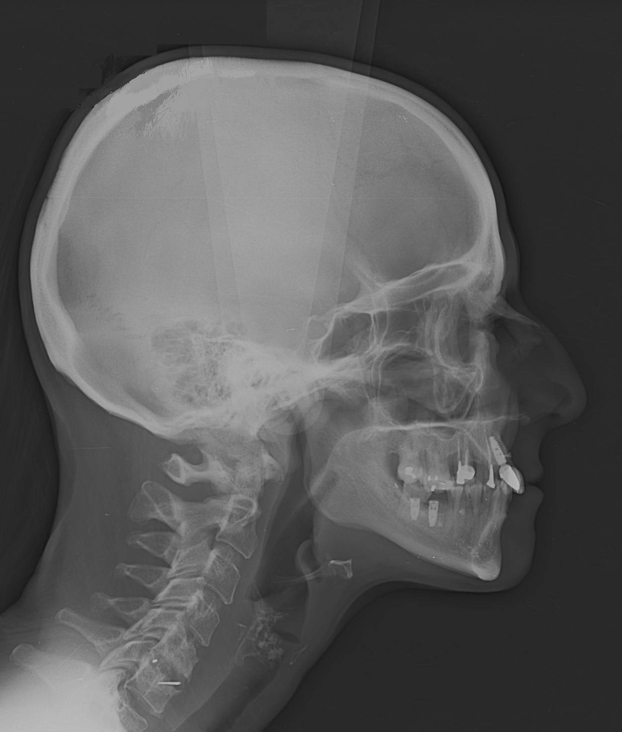 Téléradiographie de profil nécessaire au bilan orthodontique au Cabinet Dentaire Maupassant 13008