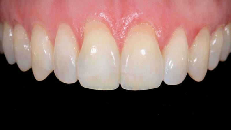 Récession et déchaussement parodontale Marseille