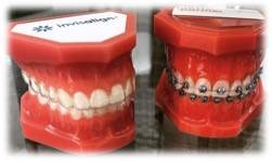 Gouttières invisalign ou traitement classique à Marseille