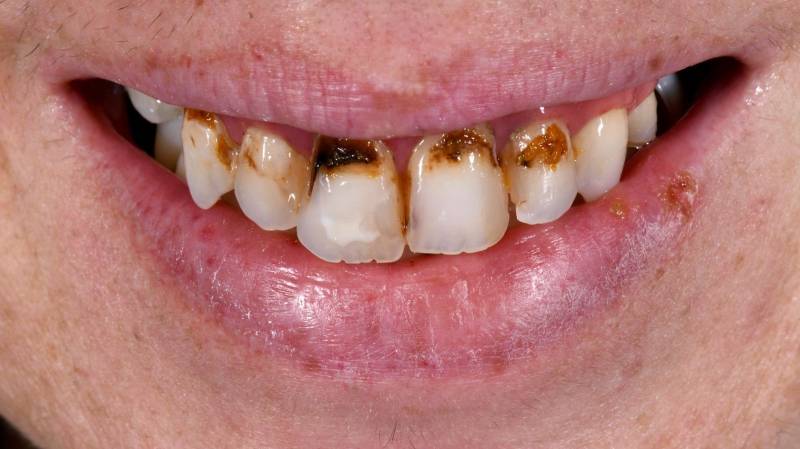 Dents cariées Dent abimées Je n'aime pas mon sourire
