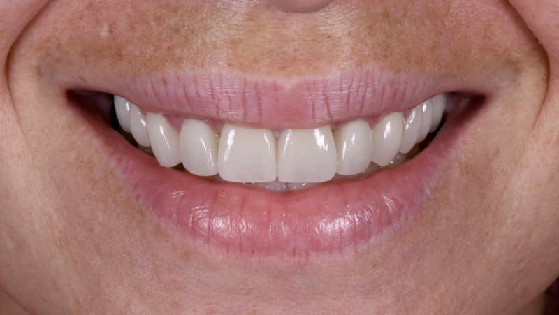 Nouveau sourire esthétique avec les facettes céramiques