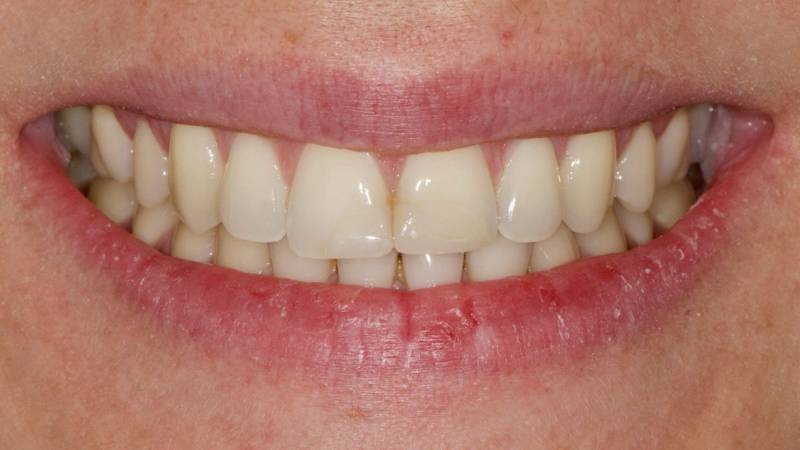 Je n'aime pas mon sourire - Dents jaunes-