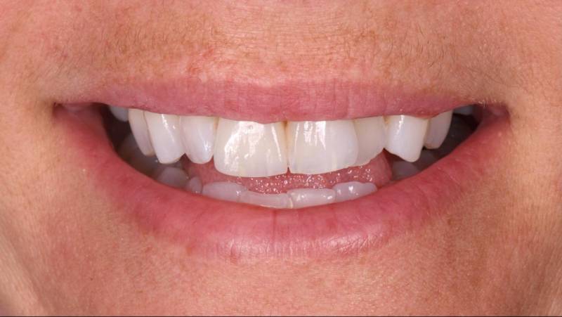 Sourire esthétique dents blanches facette dentaire céramique et dent à pivot (couronne zircone) Martigues