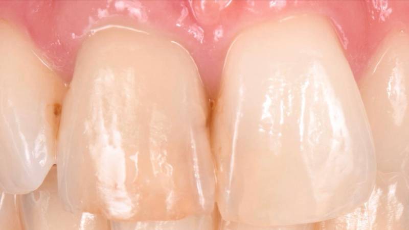 Dent jaune et dévitalisée composites inesthétiques je n'aime pas mes dents Martigues