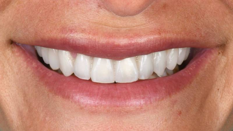 Jolie sourire naturel avec facettes implant et blanchiment dentaire