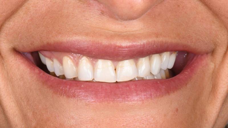 Gencives visibles dents courtes dents jaunes