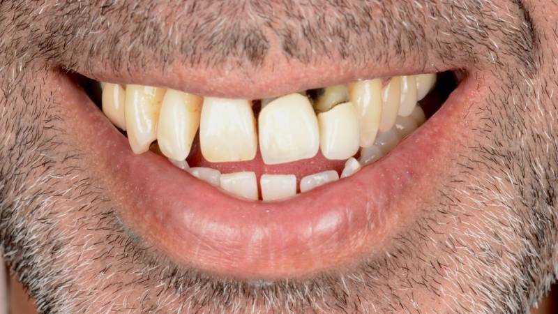 Dents qui bougent dents espacées maladie parodontale
