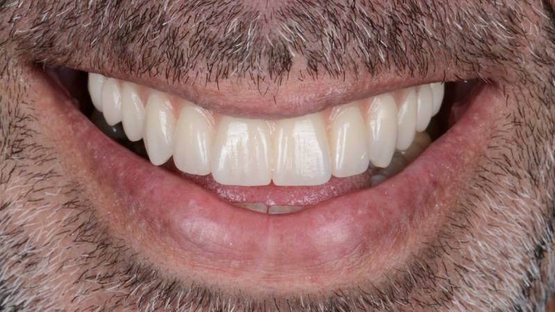 Dents alignées dents blanches nouveau sourire