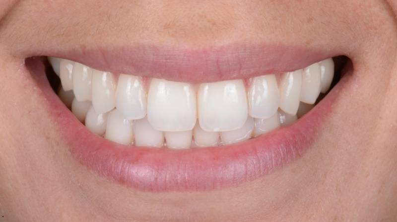 Sourire blanc après blanchiment dentaire professionnel à Marseille (13008) – résultats visibles après traitement au Cabinet Dentaire Maupassant