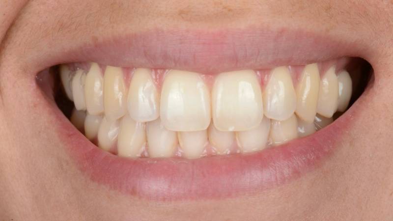 Dents jaunes avant blanchiment dentaire à Marseille (13008) – traitement pour éclaircir les dents jaunes, Cabinet Dentaire Maupassant