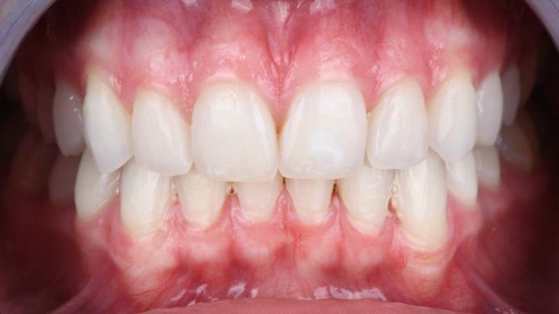 Teinte des dents éclaircie après blanchiment dentaire professionnel