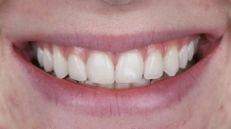 Sourire plus blanc après blanchiment dentaire professionnel à Marseille (13008) – résultats visibles et durables au Cabinet Dentaire Maupassant