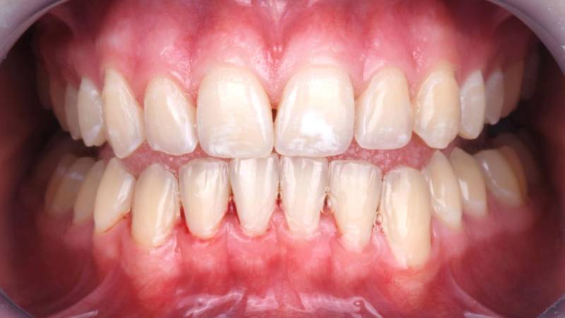 Dents pas blanches avant blanchiment dentaire