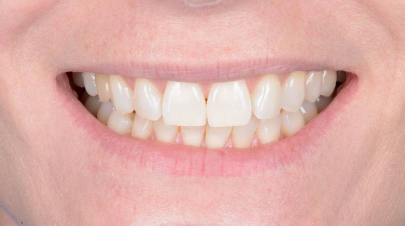 Dents plus blanches après blanchiment dentaire professionnel – résultat réel