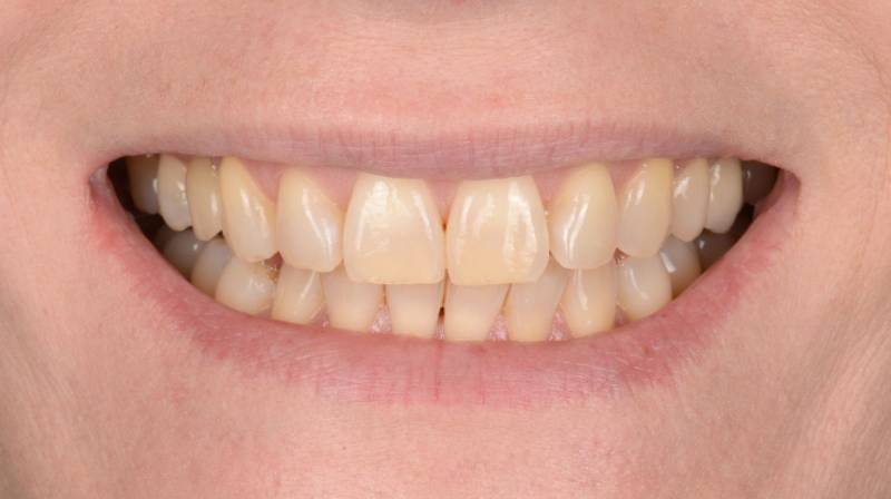 Dents foncées avant traitement d’éclaircissement dentaire (Marseille 13008)