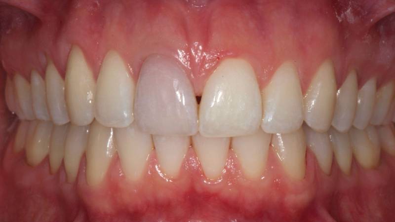 Dents jaunes avant traitement de blanchiment dentaire à Marseille (13008) – avant/après traitement au Cabinet Dentaire Maupassant