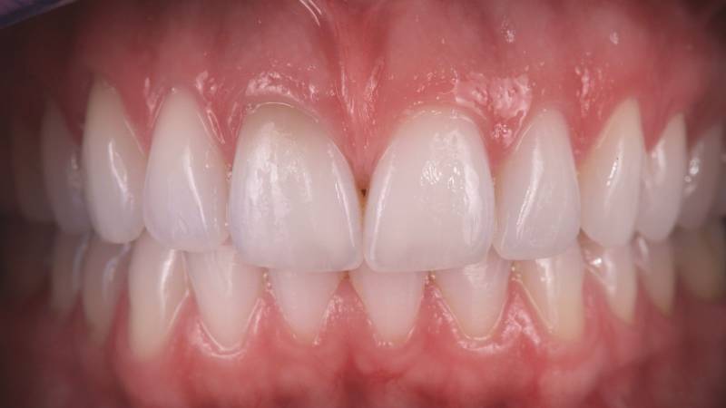 dents nettement plus lumineuses après blanchiment dentaire à Marseille (13008) – résultats visibles et durables