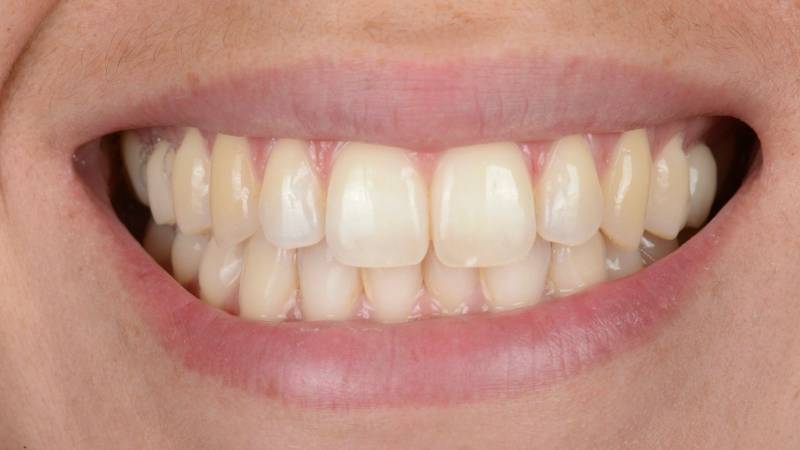 J'ai les dents très jaunes