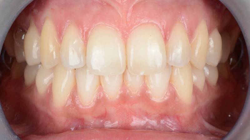 Dents jaunies avec le temps avant éclaircissement dentaire à Marseille (13008) – solution efficace au Cabinet Dentaire Maupassant