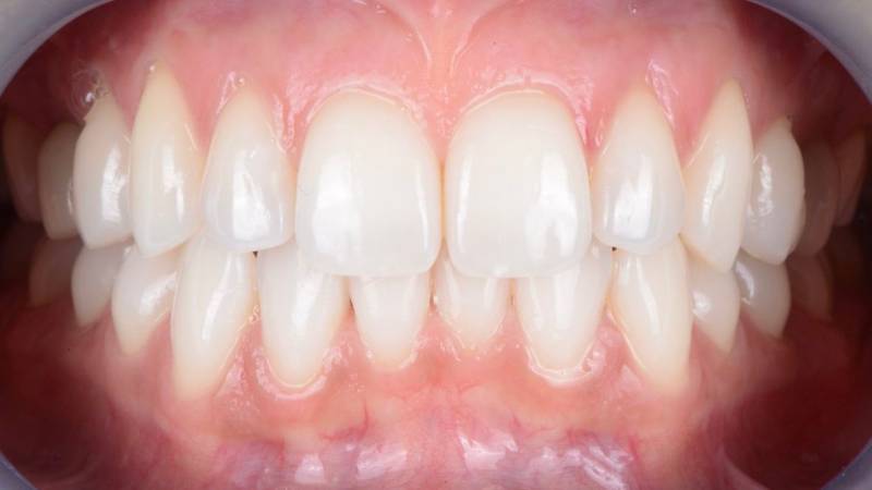 Avant/après : dents éclaircies grâce aux techniques de blanchiment dentaire professionnel à Marseille (13008) – résultats durables au Cabinet Dentaire Maupassant