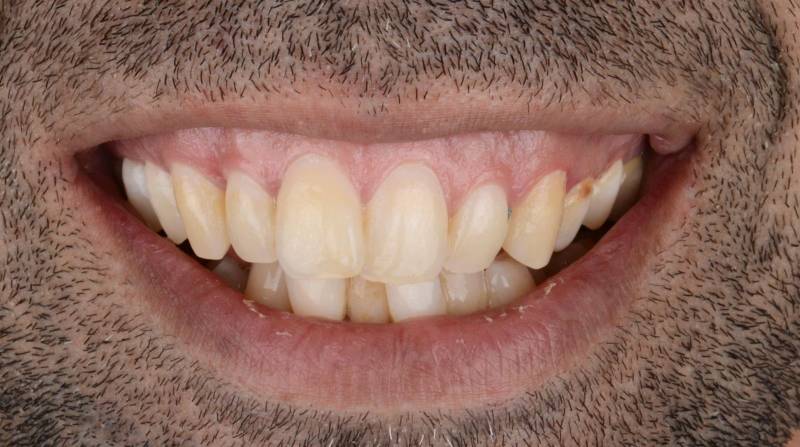 Avant traitement au Cabinet Dentaire Maupassant à Marseille Prado (13) : dents non alignées, caries profondes, dents absentes et début de maladie parodontale. Sourire abîmé, douleurs à la mastication et gêne esthétique au quotidien.