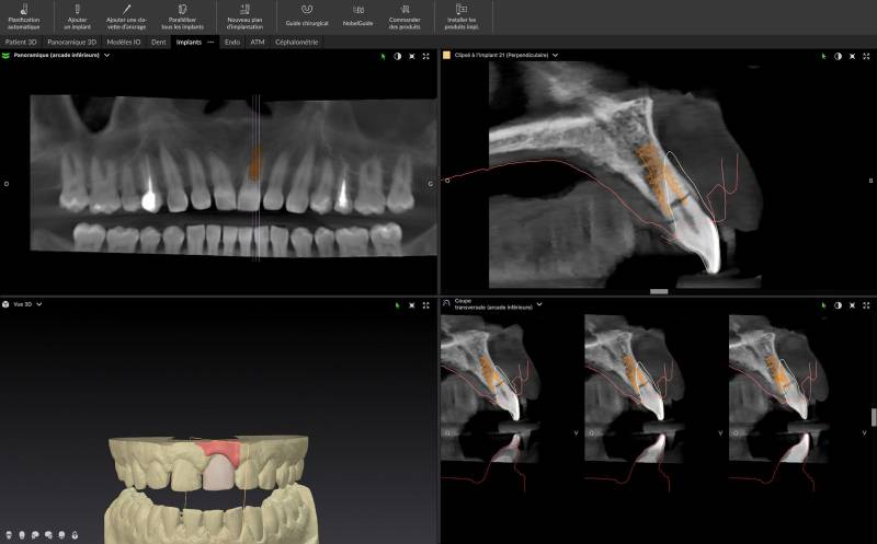 Bilan implantaire à Marseille : analyse 3D Cone Beam et planification précise avant la pose d’un implant dentaire.