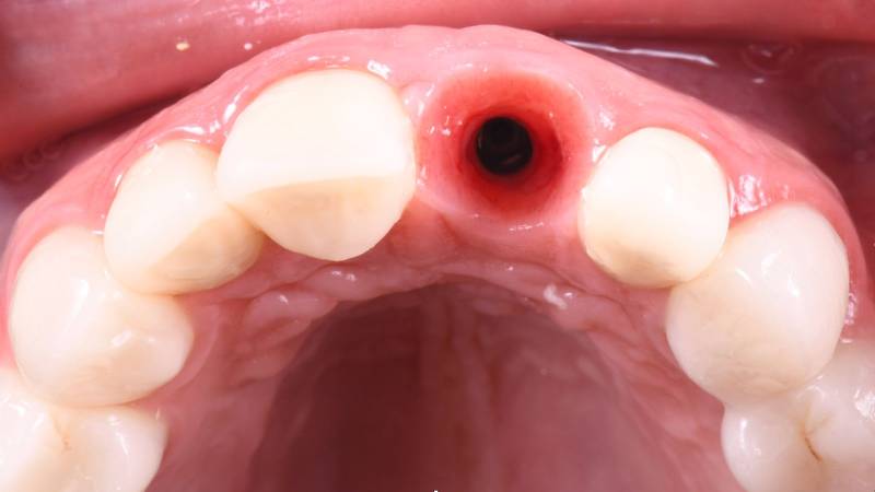 Pose d'un implant dentaire avant la pose de la couronne implantaire en zircone.