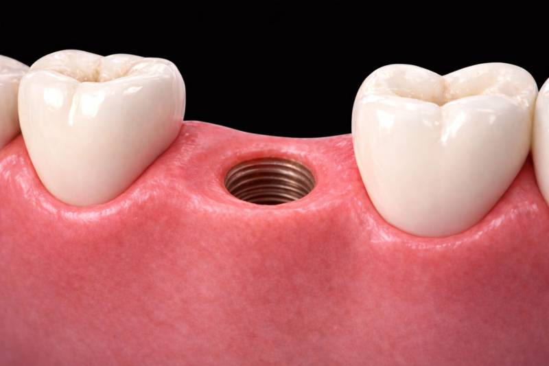 Solutions en cas de rejet d’un implant dentaire à Marseille (13008)