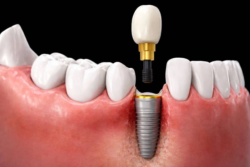 Couronne dentaire vissée sur implant permettant de remplacer une dent absente à Marseille
