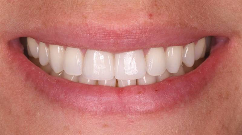 Joli sourire après blanchiment dentaire facette céramique et implant dentaire