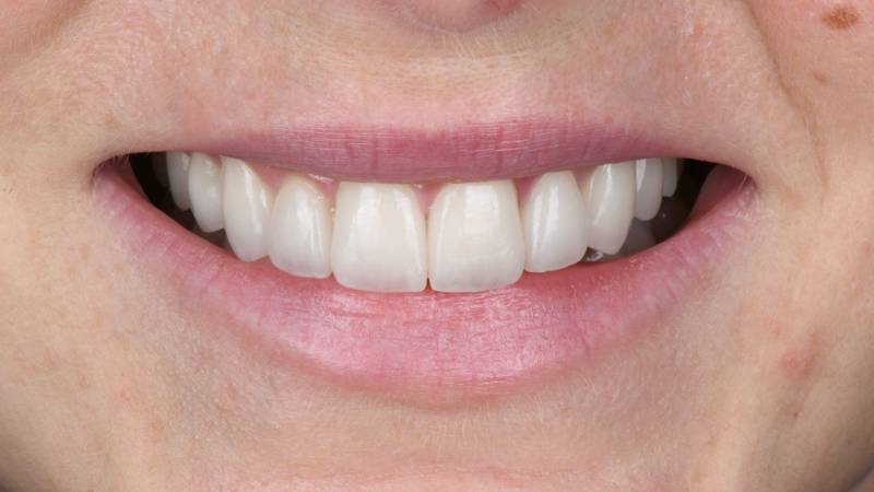 Dents blanches, dent alignées, sourire jolie, blanchiment, facettes céramique