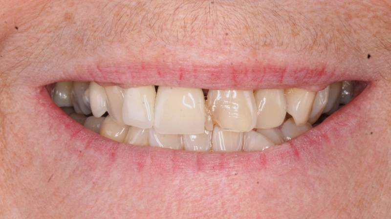 Dents cassées dents absentes maladie parodontale dent non alignées dents jaunes femme de 69 ans
