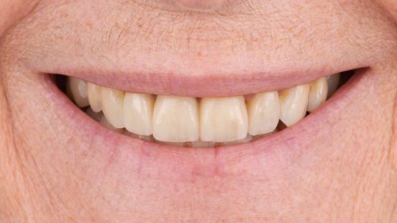 Pose implant dentaire Facettes céramique et Orthodontie invisible Marseille 13