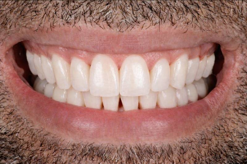 Dents alignées grace aux gouttières invisibles