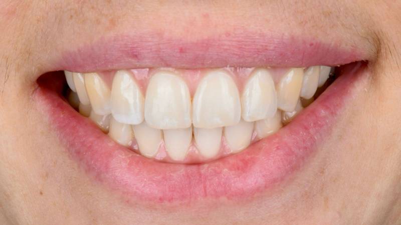 Dents pas blanches avant traitement de blanchiment dentaire à Marseille