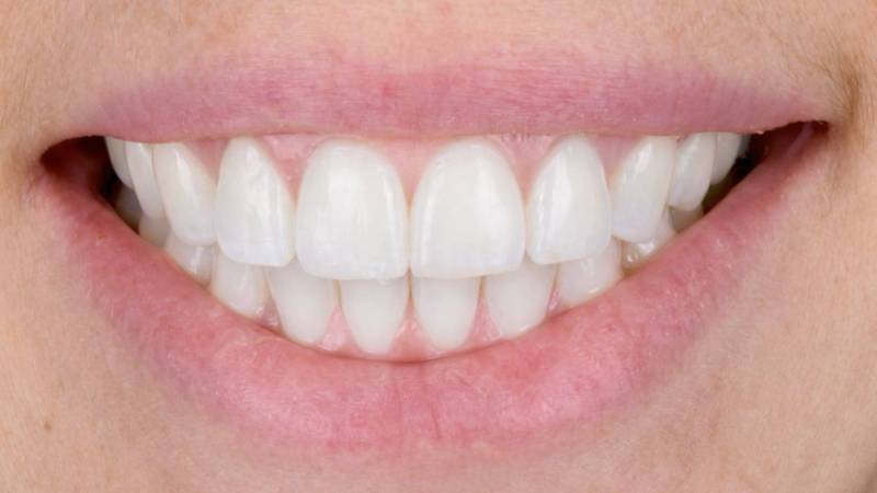 Sourire éclatant 5 ans après un blanchiment dentaire professionnel – Résultat durable à Marseille 13008