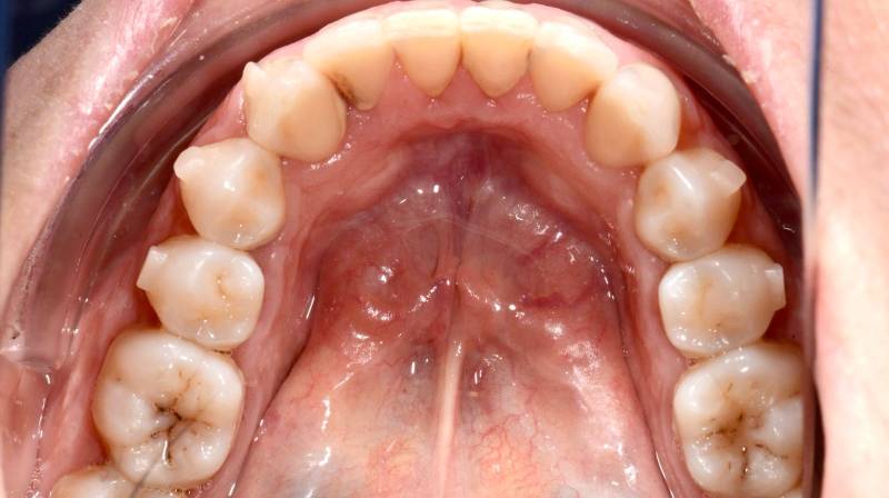 Dents alignées après traitement invisalign
