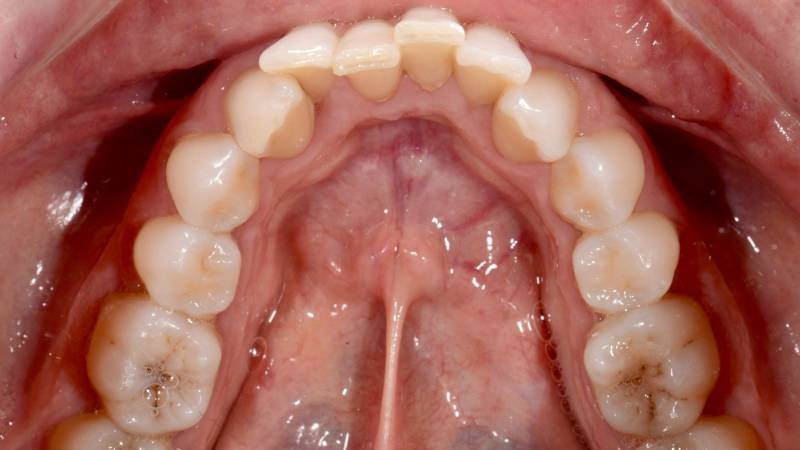 Hygiène difficile avant traitement orthodontique de l'adulte