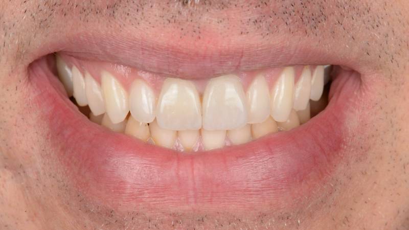 Facettes dentaires céramiques orthodontie invisible et blanchiment dentaire