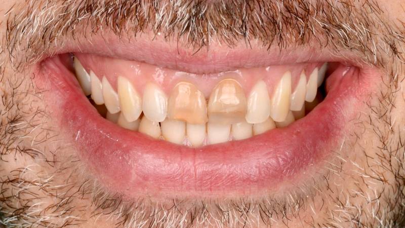 Dents cassées - Dent marrons - Dents colorées - Dent noires - dents pas jolies