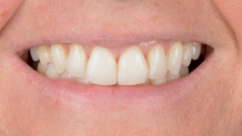 Résultat d'un traitement par greffe gingivale implantologie orthodontie et blanchiment dentaire
