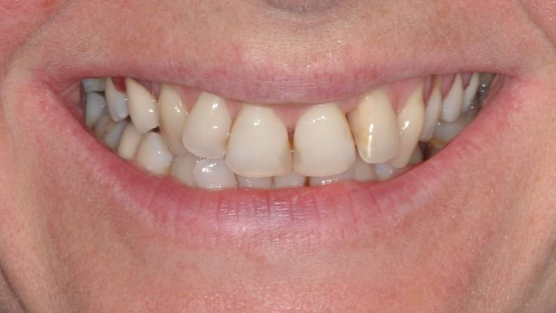 Récessions gingivales, dent jaunes, dents pas alignées dents manquante et composites visibles