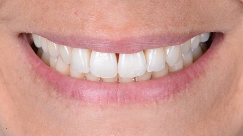 Jolie sourire Dents alignées Dents Blanches Dents saines