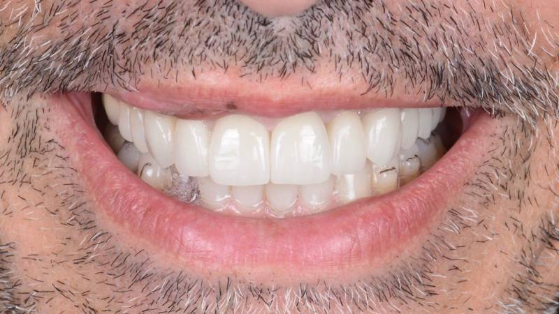 Facettes couronnes orthodontie greffe de gencive et blanchiment dentaire pour un joli sourire