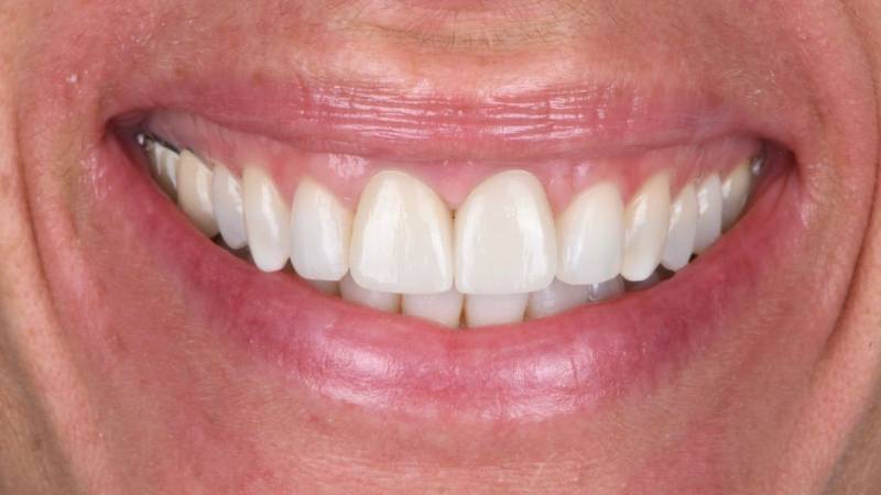Joli sourire avec dent alignée (orthodontie invisible)