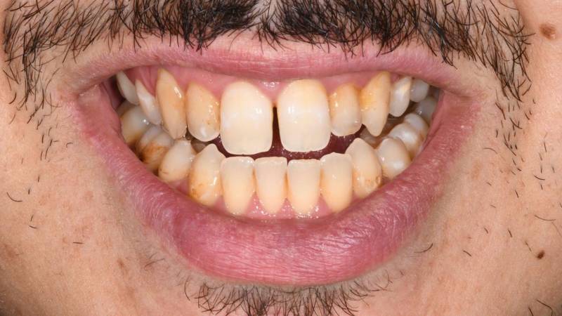 Je n'aime pas mon sourire je n'aime pas mes dents jaunes Marseille Bouche du Rhônes 13