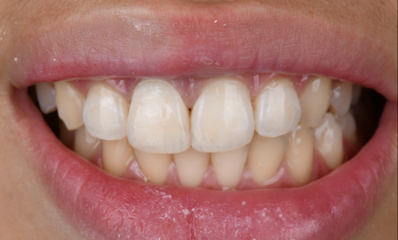 Sourire après réalisation de restaurations en composite esthétique au cabinet dentaire Maupassant Marseille
