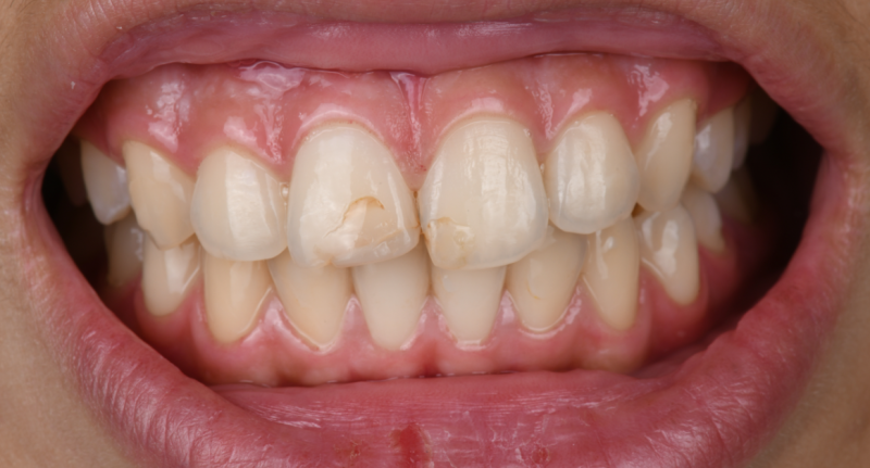 Sourire avant reprise des composites