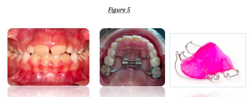 Mâchoire du haut/du bas trop étroite : pas de place pour toutes les dents 